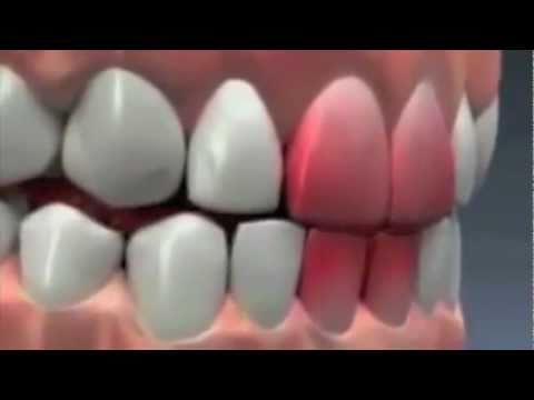 Bruxism