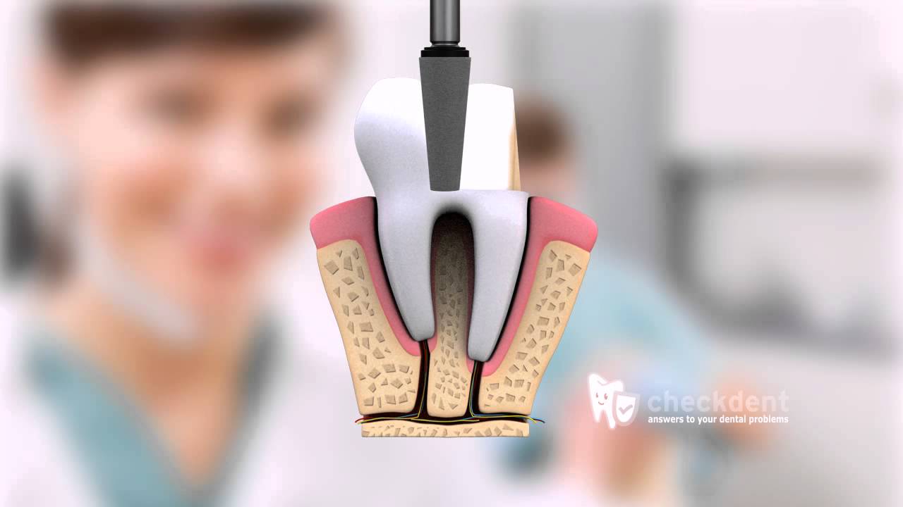 What is a perfect Dental Crown