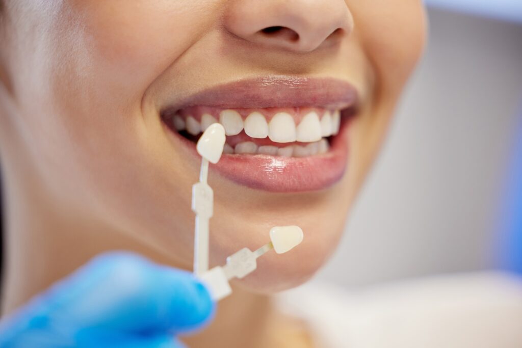 Woman’s teeth being color-matched for porcelain veneers at a dental office in Orlando